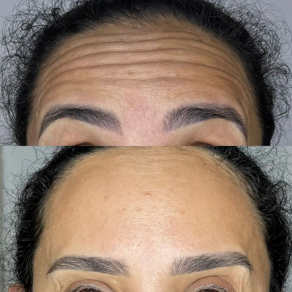 Antes e depois de tratamento facial na Ana Paula Estética