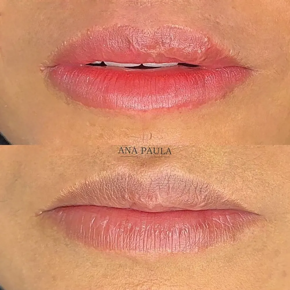 Antes e depois de labial com cobertura na Ana Paula Estética