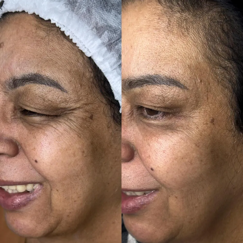 Antes e depois de limpeza de pele na Ana Paula Estética