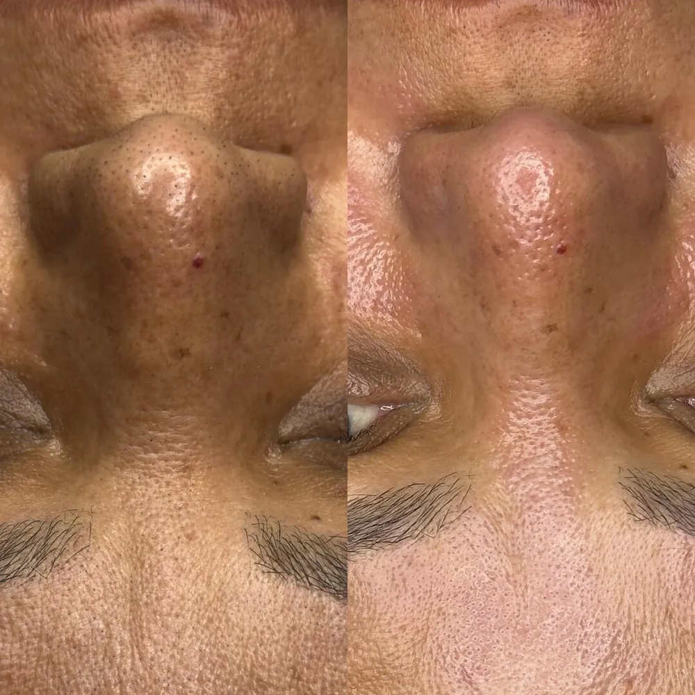Antes e depois de neutralização labial na Ana Paula Estética